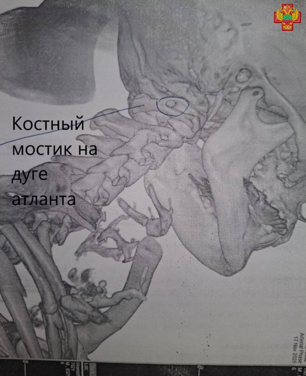 Мелитопольские нейрохирурги впервые в Запорожской области провели операцию при аномалии Киммерли